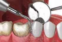 Cạo Vôi & Đánh Bóng