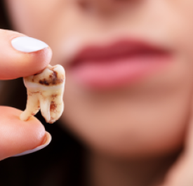 Cách Phòng Ngừa Sâu Răng Hiệu Quả – Bí Quyết Giữ Gìn Nụ Cười Khỏe Mạnh